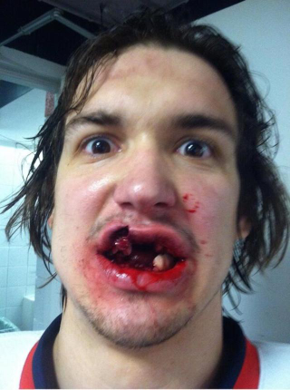 Illustration for article titled Red Wings Prospect Takes Puck To Mouth, Tweets Photo Of Aftermath
